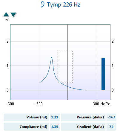 226 hertz tympanogram with a volume in ml of 1.31, a compliance in ml of 1.35, a pressure in daPa of minus 167, and a gradient in daPa of 72.