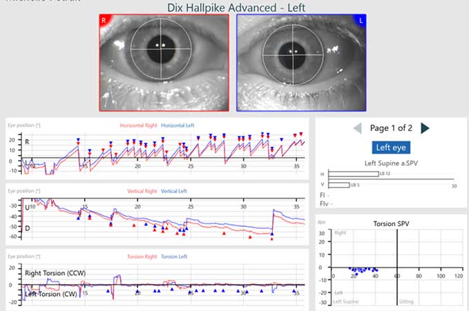 Software screen following data collection in an Advanced Dix-Hallpike left test in a patient who has left posterior canal BPPV. The horizontal, vertical, and torsional eye movement graphs all show positive findings of BPPV.