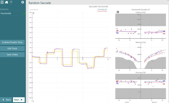 Results overview for horizontal saccade test. Red and blue curves for right and left eye movements follow the yellow curve for target position smoothly and quickly. Graphs for latency, velocity, and accuracy show normal results, with results located in the white, normal regions, and not in the grey, abnormal regions.