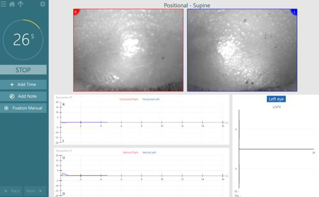 Supine positional test screen. The software has started recording eye movements, but the patient’s eyes are closed, visible through the live video eye images.