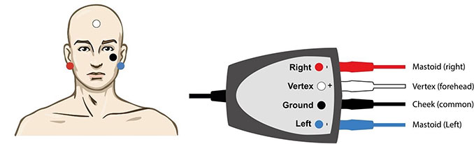 Man with right electrode on the right mastoid, vertex electrode on the vertex, ground electrode on the cheek, and left electrode on the left mastoid. Right electrode is red. Vertex electrode is white. Ground electrode is black. Left electrode is blue.