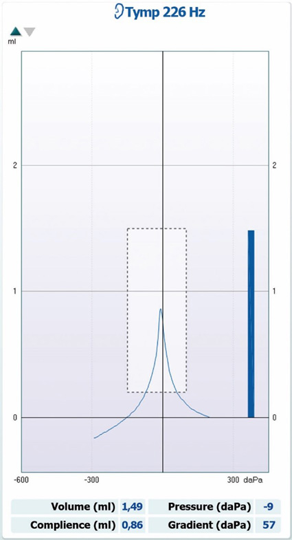Ear canal volume of 1.49 ml, compliance of 0.86 ml, pressure of minus 9 daPa, and gradient of 57 daPa.