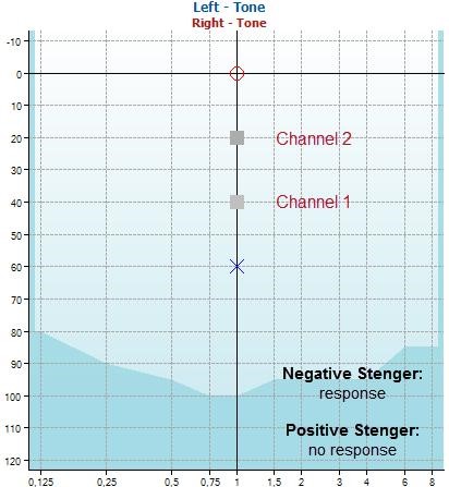 Stenger test example with a two-channel audiometer