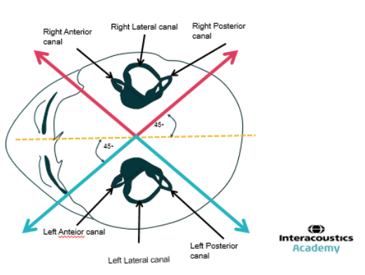 An image looking down into the anterior canal, lateral canal and posterior canal on each side.
