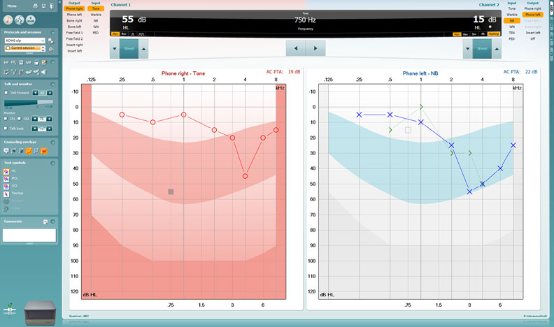 Diagramme zeigen Pegel (dB HL) in Abhängigkeit zu Frequenzen (kHz). Die Werte des rechten Ohres zeigen verschiedene Schwellenwerte, wie z.B. 5 dB HL bei 0,25 kHz.