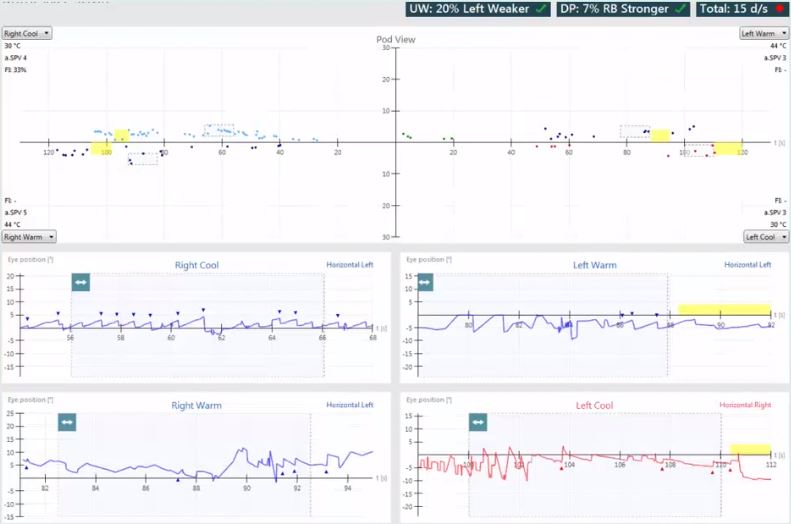 Results overview with pod and eye position views for right cool, right warm, left warm, and left cool irrigations. Unilateral weakness of 20%, left weaker. Directional preponderance of 7%, right-beating nystagmus stronger. For right cool, the average slow phase velocity is 4 and the fixation index is 33%. For right warm, the average slow phase velocity is 5 with no calculated fixation index. For left warm, the average slow phase velocity is 3 with no calculated fixation index. For left cool, the average slow phase velocity is 3 with no calculated fixation index.