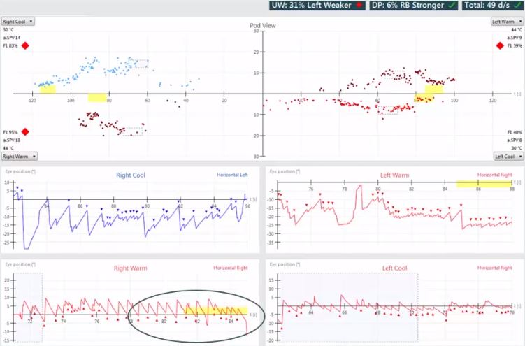 Results overview with pod and eye position views for right cool, right warm, left warm, and left cool irrigations. Unilateral weakness of 31%, left weaker. Directional preponderance of 6%, right-beating nystagmus stronger. For right cool, the average slow phase velocity is 14 and the fixation index is 83%. For right warm, the average slow phase velocity is 18 and the fixation index is 95%. For left warm, the average slow phase velocity is 9 and the fixation index is 59%. For left cool, the average slow phase velocity is 8 and the fixation index is 40%.