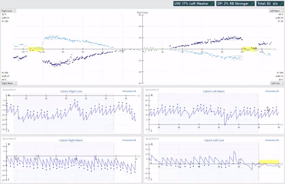 Results overview with pod and eye position views for right cool, right warm, left warm, and left cool irrigations. Unilateral weakness of 17%, left weaker. Directional preponderance of 2%, right-beating nystagmus stronger. For right cool, the average slow phase velocity is 21 and the fixation index is 13%. For right warm, the average slow phase velocity is 27 and the fixation index is 23%. For left warm, the average slow phase velocity is 19 and the fixation index is 7%. For left cool, the average slow phase velocity is 15 and the fixation index is 10%.