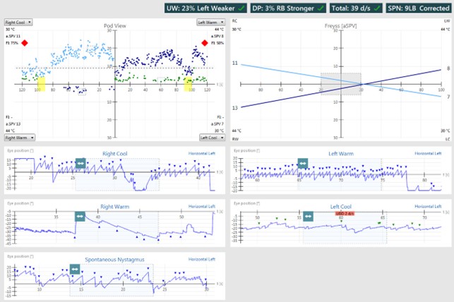 Results overview with pod and eye position views for right cool, right warm, left warm, and left cool irrigations. Unilateral weakness of 23%, left weaker. Directional preponderance of 3%, right-beating nystagmus stronger. For right cool, the average slow phase velocity is 11 and the fixation index is 75%. For right warm, the average slow phase velocity is 13 and the fixation index is not calculated. For left warm, the average slow phase velocity is 8 and the fixation index is 58%. For left cool, the average slow phase velocity is 7 and the fixation index is not calculated.
