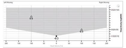 Horizontal static visual acuity of -0.3 LogMAR. Leftward DVA of 0.6 LogMAR. Rightward DVA of 0.0 LogMAR.