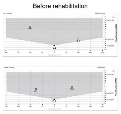 Horizontal static visual acuity of -0.3 LogMAR. Leftward DVA of 0.6 LogMAR. Rightward DVA of 0.0 LogMAR. Vertical static visual acuity of -0.3 LogMAR. Downward DVA of 0.2 LogMAR. Upward DVA of 0.3 LogMAR.