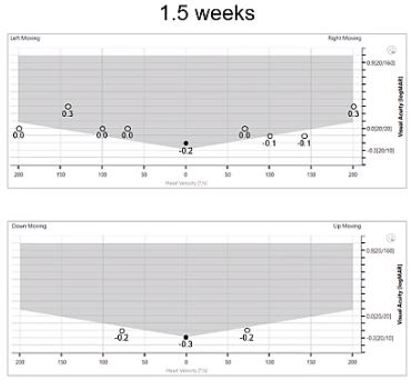 Horizontal static visual acuity of -0.2 LogMAR. Leftward DVA ranging between 0.0 to 0.3 LogMAR. Rightward DVA ranging between -0.1 to 0.3 LogMAR. Vertical static visual acuity of -0.3 LogMAR. Downward DVA of -0.2 LogMAR. Upward DVA of -0.2 LogMAR.