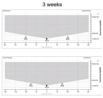Horizontal static visual acuity of -0.3 LogMAR. Leftward DVA of -0.2 LogMAR. Rightward DVA of -0.2 LogMAR. Vertical static visual acuity of -0.3 LogMAR. Downward DVA of -0.2 LogMAR. Upward DVA of -0.2 LogMAR.
