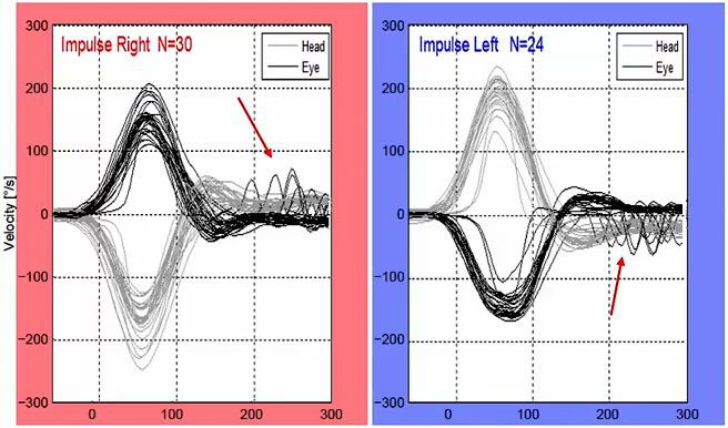 Velocity data graphs for right-left impulses showing head and eye curves with degrees as a function of seconds. The head and eye movements match nicely in both directions. In both directions, from 200 to 300 milliseconds, there are small-velocity catch-up saccades of about 50 degrees.