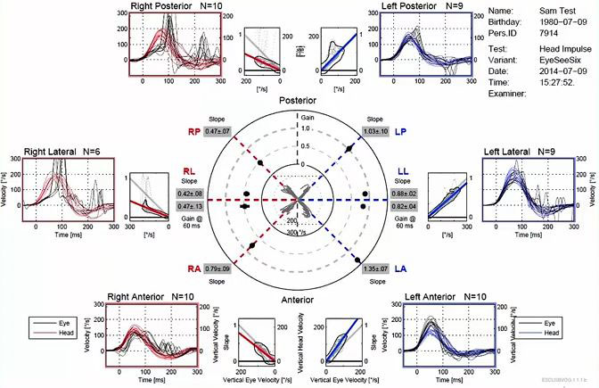 Median gain at 60 milliseconds is 0.47 for right posterior, 0.47 for right lateral, and 0.79 for right anterior. All below the normative cutoff of 0.8.