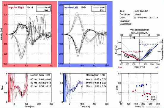 Velocity and gain data graphs showing vHIT results. The velocity graphs for the right-left impulses show head and eye curves with degrees as a function of seconds. The head and eye movements match poorly in the rightward direction but match within normal range in the leftward direction. In the right direction, the median gain at 60 milliseconds is 0.42. In the left direction, the median gain at 60 milliseconds is 0.87.
