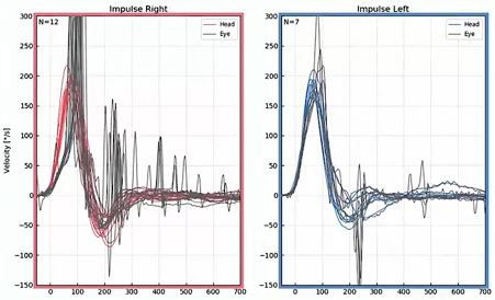 The head movement curves are red for right impulses and blue for left impulses. This gives a better contrast to the black curves for eye movements. With the data overlapped and the data range increased to 700 milliseconds, the spikes of spontaneous nystagmus are much more visible, from 200 milliseconds and onward in both directions.