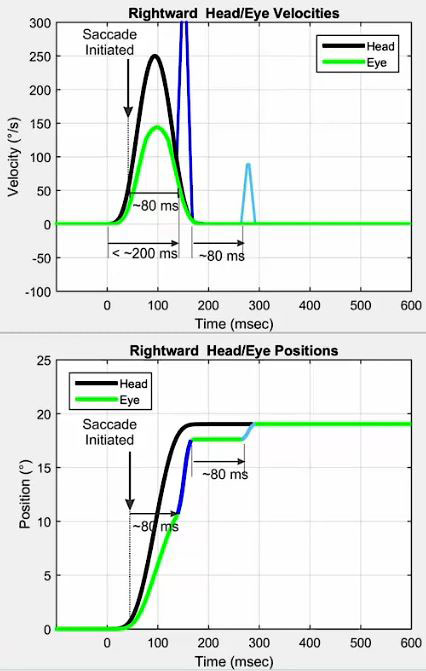 Velocity and position graphs. In the velocity graph, the head and eye movements are plotted with velocity, in degrees per second, as a function of time, in milliseconds. At 0 milliseconds, the head impulse is initiated, with a peak head velocity of 250 degrees per second. At first, the eye velocity peaks at 150 degrees per second. Toward and during the end of the head impulse, a large corrective eye movement is visible with a velocity of more than 300 degrees per second. A small overt saccade is also visible 80 milliseconds after the end of the head impulse, with a velocity of about 90 degrees per second. In the position graph, the head and eye movements are plotted with position, in degrees, as a function of time, in milliseconds. At 0 milliseconds, the head impulse is initiated, and the head quickly moves into an 18-degree position. The eye only reaches 12 degrees at first, followed by an immediate, covert eye movement to reach about 17 degrees. After a further 80 milliseconds, a final, overt eye movement is made to reach the 18 degrees.