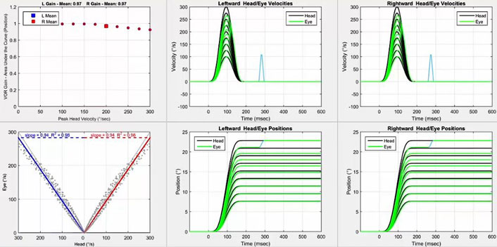Six graphs in total. Firstly, a graph with VOR gain as a function of peak head velocity in degrees per second. For both directions, the gain is 1 until slowly dropping off from 175 degrees per second. For all velocities, the gain is well above the cutoff of 0.8. Secondly, a graph with eye velocity in degrees per second as a function of head velocity in degrees per second. To show data for both leftward and rightward impulses, the x-axis is split into two identical portions, with a head velocity of zero degrees per second in the middle, ranging up to 300 degrees per second on either side for each head impulse direction. Thus, a VOR gain of 1 would yield a line where head and eye velocity were always equal. For both directions, the scatter plot hovers closely to this line, yielding a correlation of just below 1 that is nice and clear with its V-shape. Thirdly and fourthly, we have the velocity and position graphs for the leftward impulses. In the velocity graph, the head and eye movements are plotted with velocity, in degrees per second, as a function of time, in milliseconds. For velocity, the peak eye velocities match nicely with the peak head velocities up to 250 degrees per second. In the position graph, the head and eye movements are plotted with position, in degrees, as a function of time, in milliseconds. For position, the eye positions match nicely with the head positions up to 15 degrees, after which they begin to drop off, with an overt saccade required to reach an impulse where the head reached 23 degrees. Fifthly and sixthly, we have the velocity and position graphs for the rightward impulses. They exhibit the exact same response patterns as for the leftward impulses.