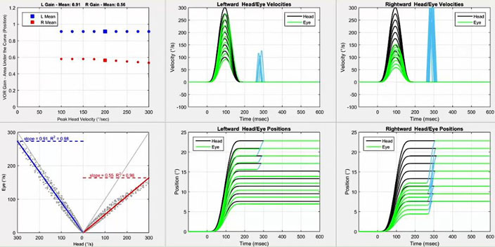 Six graphs in total. Firstly, a graph with VOR gain as a function of peak head velocity in degrees per second. For the left impulses, the gain is below 1 but above the cutoff of 0.8 for all head velocities. For the right impulses, the gain is between 0.5 to 0.6 for all head velocities. Secondly, a graph with eye velocity in degrees per second as a function of head velocity in degrees per second. To show data for both leftward and rightward impulses, the x-axis is split into two identical portions, with a head velocity of zero degrees per second in the middle, ranging up to 300 degrees per second on either side for each head impulse direction. Thus, a VOR gain of 1 would yield a line where head and eye velocity were always equal. For the left impulses, the scatter plot hovers quite closely to this line, slightly below toward the higher head velocities, yielding a slope of 0.91. For the right impulses, the scatter plot is way below this line, yielding a slope of 0.55. Thirdly and fourthly, we have the velocity and position graphs for the leftward impulses. In the velocity graph, the head and eye movements are plotted with velocity, in degrees per second, as a function of time, in milliseconds. For velocity, the peak eye velocities match nicely with the peak head velocities up to 275 degrees per second. In the position graph, the head and eye movements are plotted with position, in degrees, as a function of time, in milliseconds. For position, the eye positions immediately lag behind the head positions, with overt saccades required to match the head positions at 17 degrees and above. Fifthly and sixthly, we have the velocity and position graphs for the rightward impulses. For velocity, the peak eye velocities only match nicely with the peak head velocities up to 150 degrees per second. High-velocity overt saccades occur at 300 milliseconds. For position, overt saccades are required to match all head positions.