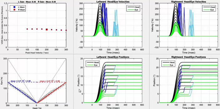 Six graphs in total. Firstly, a graph with VOR gain as a function of peak head velocity in degrees per second. For both directions, the gain hovers just below 0.5 for all head velocities. Secondly, a graph with eye velocity in degrees per second as a function of head velocity in degrees per second. To show data for both leftward and rightward impulses, the x-axis is split into two identical portions, with a head velocity of zero degrees per second in the middle, ranging up to 300 degrees per second on either side for each head impulse direction. Thus, a VOR gain of 1 would yield a line where head and eye velocity were always equal. For both directions, the scatter plots hover way below this line, yielding slopes of 0.47. The remaining four graphs are the velocity and position graphs for leftward and rightward impulses. In the velocity graph, the head and eye movements are plotted with velocity, in degrees per second, as a function of time, in milliseconds. For both directions, the peak eye velocities only match nicely with the peak head velocities up to 125 degrees per second. For both directions, quite significant overt saccades occur at 250 to 300 milliseconds. For both directions, covert saccades occur toward the end of the head impulse. In the position graph, the head and eye movements are plotted with position, in degrees, as a function of time, in milliseconds. For both directions, a mix of overt and covert saccades are performed for all head positions.