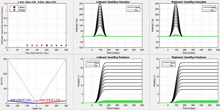 Six graphs in total. Firstly, a graph with VOR gain as a function of peak head velocity in degrees per second. For both directions, the gain hovers below 0.1 for all head velocities. Secondly, a graph with eye velocity in degrees per second as a function of head velocity in degrees per second. To show data for both leftward and rightward impulses, the x-axis is split into two identical portions, with a head velocity of zero degrees per second in the middle, ranging up to 300 degrees per second on either side for each head impulse direction. Thus, a VOR gain of 1 would yield a line where head and eye velocity were always equal. For both directions, the scatter plots hover way below this line, yielding slopes of 0.06. The remaining four graphs are the velocity and position graphs for leftward and rightward impulses. In the velocity graph, the head and eye movements are plotted with velocity, in degrees per second, as a function of time, in milliseconds. For both directions, the peak eye velocities come nowhere near the peak head velocities. In the position graph, the head and eye movements are plotted with position, in degrees, as a function of time, in milliseconds. For both directions, the eye positions come nowhere near the head positions.