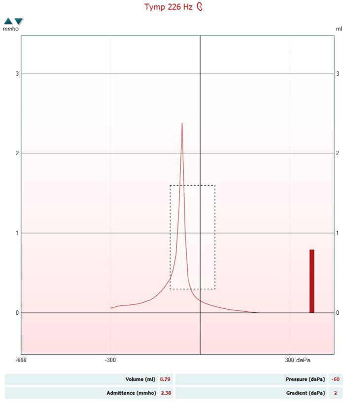 The tympanogram has the following values. Volume, measured in ml, is 0.79. Pressure, measured in daPa, is minus 60. Admittance, measured in mmho, is 2.38. Gradient, measured in daPa, is 2. These values produce a curve with a very sharp and tall peak at minus 60 daPa.