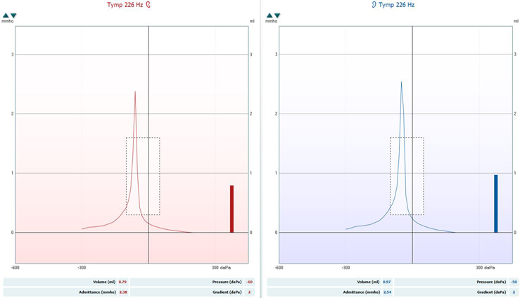 The tympanogram in the right ear has the following values. Volume, measured in ml, is 0.79. Pressure, measured in daPa, is minus 60. Admittance, measured in mmho, is 2.38. Gradient, measured in daPa, is 2. These values produce a curve with a very sharp and tall peak at minus 60 daPa. The tympanogram in the left ear has the following values. Volume, measured in ml, is 0.97. Pressure, measured in daPa, is minus 50. Admittance, measured in mmho, is 2.54. Gradient, measured in daPa, is 2. These values produce a curve with a very sharp and tall peak at minus 50 daPa.