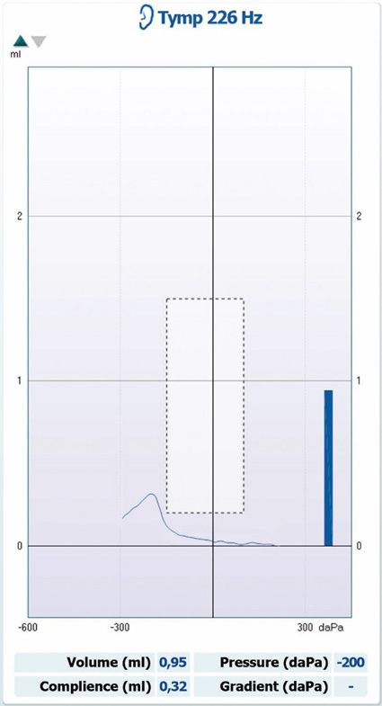 Ear canal volume of 0.95 ml, compliance of 0.32 ml, pressure of minus 200 daPa, and no measurable gradient.