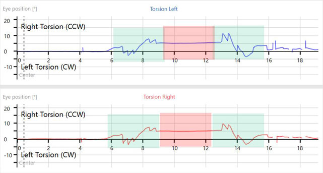 Ocular counter roll test software screen, showing torsional recordings.