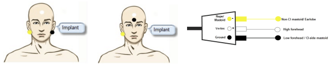 Man with to options for electrode placement displayed. In the first example, the man has an electrode on the non CI mastoid, the vertex electrode on the high forehead, and the ground elecrode on the CI mastoid. In the second example, the man has an electrode on the non CI mastoid, the vertex electrode on the high forehead, and the ground electrode on the low forehead.