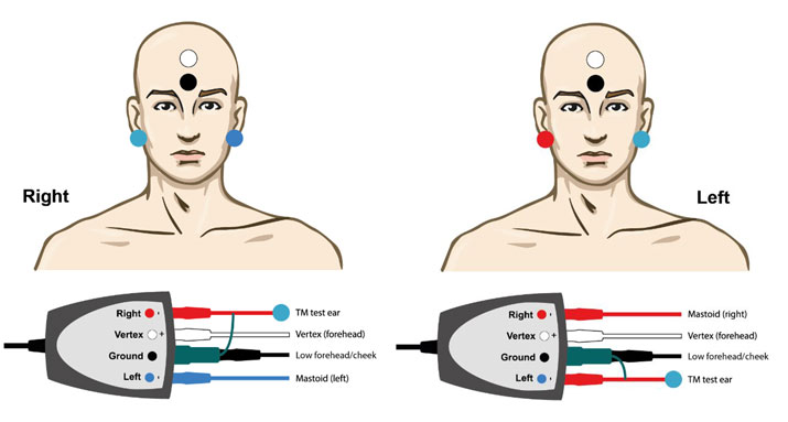 TM-trode cable in test ear, with electrode on opposite mastoid, forehead, and ground electrode on low forehead.