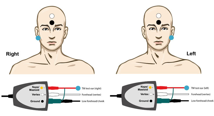 TM-trode cable in test ear, electrode on forehead, and ground electrode on low forehead.