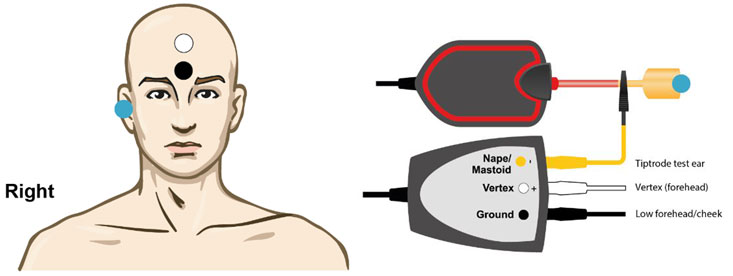TipTrode in test ear, electrode on forehead, and ground electrode on low forehead.