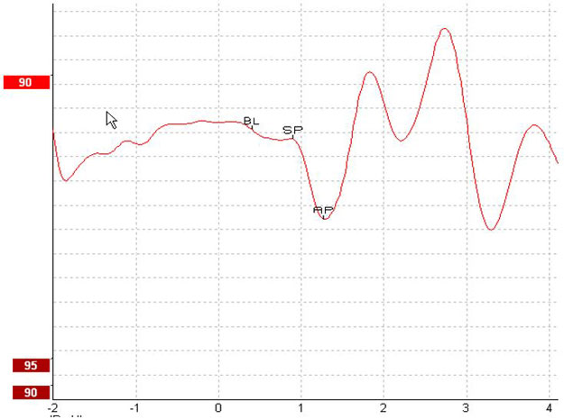 Baseline at about 0.4 milliseconds. Summating potential at about 0.85 milliseconds. Action potential at about 1.3 milliseconds.