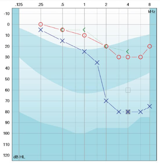 Audiogram with dB HL as a function of kHz. Between 0.25 to 8 kHz, the thresholds in the right ear range between 0 to 30 dB HL. In the left ear, the thresholds are higher, and substantially higher between 2 to 8 kHz, where the tresholds range between 70 to 80 dB HL.