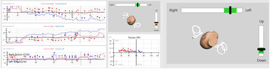3D image of a head, with semicircular canals displayed for both ears. The x-axis ranges from right to left, and the y-axis ranges from down to up. A green shaded area on both axes displays where to point the head, and a black marker indicates whether the patient's head is pointed correctly. Both black markers are in the green region, and the 3D head is pointing accordingly. In this instance, to the left and down.