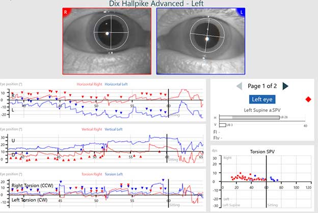 Results for eye position, average slow phase velocity, and torsion velocity are displayed in separate graphs. BPPV is detected, indicated by a red diamond.