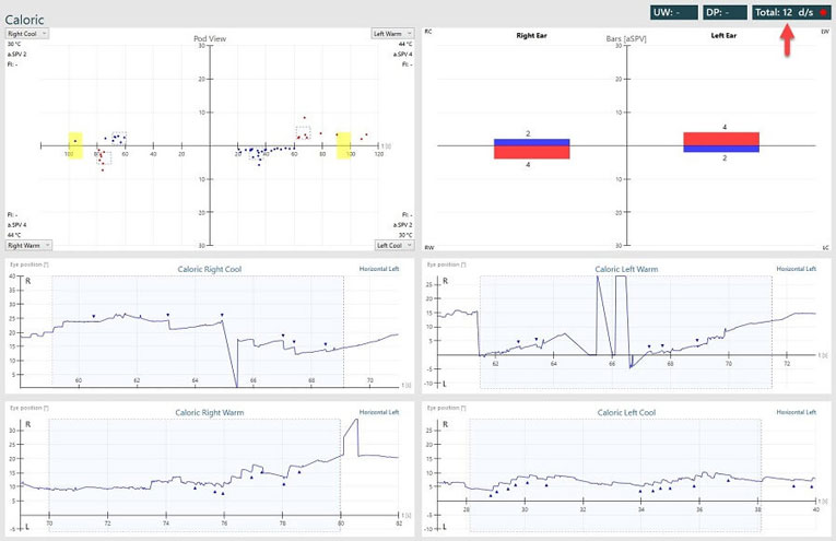 Abnormal caloric results, showing a bilateral weakness.
