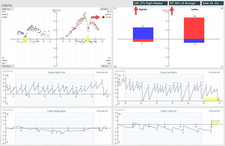 Abnormal caloric results, showing a unilateral weakness of 27% and directional preponderance of 68%.
