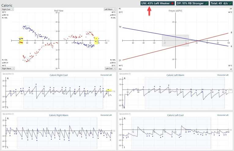 Abnormal caloric results, showing a unilateral weakness of 43%.
