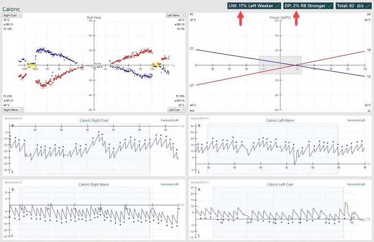 Normal caloric results, showing a unilateral weakness of 17% and directional preponderance of 2%.