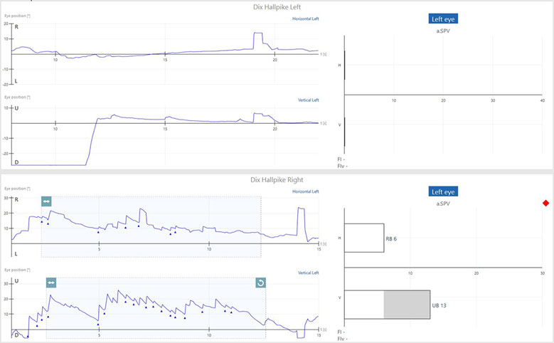 Dix-Hallpike right results showing a right-beating nystagmus with an average slow-phase velocity of 6 and an up-beating nystagmus with an average slow-phase velocity of 13.