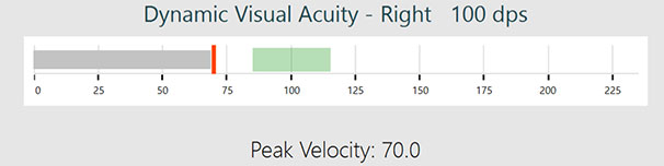 alt=Velocity bar for DVA right, 100 dps. The velocity bar is a single-axis, horizontal graph, ranging from 0 to 225 degrees per second. The proper head speed range is marked with a green area and is approximately between 85 to 115 degrees per second. The head speed in this instance is 70, indicated by a red, solid line.