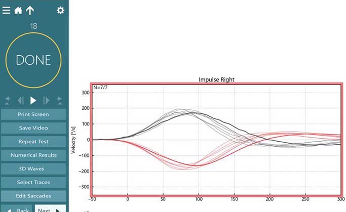 Normal right head impulse displayed in majority of the screen. A list of options are available to the left, including the following: print screen, save video, repeat test, numerical results, 3d waves, select traces, and edit saccades.