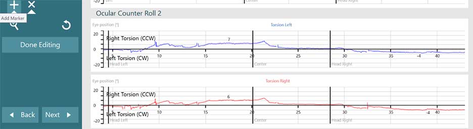 Two graphs for the left and right eyes, with eye position displayed for head left, center, and head right. For both eyes, there is a slight right torsion when the head is tilted to the left, and a slight left torsion when the head is tilted to the right.