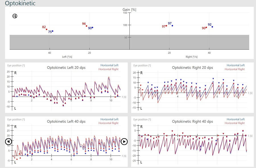 Results overview for right and left optokinetic nystagmus results, for 20 dps and 40 dps. For optokinetic left 20 dps, left horizontal gain is 90%, right horizontal gain is 96%, and eye position hovers between -10 to 20 degrees. For optokinetic left 40 dps, left horizontal gain is 75%, right horizontal gain is 82%, and eye position hovers between -5 to 20 degrees. For optokinetic right 20 dps, left horizontal gain is 97%, right horizontal gain is 97%, and eye position hovers between -10 to 15 degrees. For optokinetic right 40 dps, left horizontal gain is 92%, right horizontal gain is 90%, and eye position hovers between -20 to 5 degrees.
