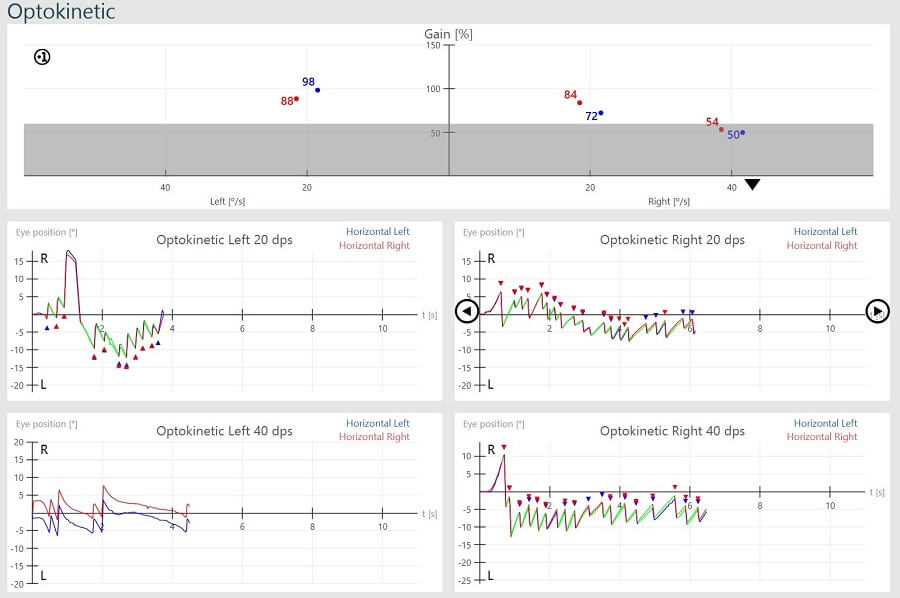 Results overview for right and left optokinetic nystagmus results, for 20 dps and 40 dps. For optokinetic left 20 dps, left horizontal gain is 98%, right horizontal gain is 88%, and eye position hovers between -15 to 20 degrees. For optokinetic left 40 dps, no gains are calculated. For optokinetic right 20 dps, left horizontal gain is 72%, right horizontal gain is 84%, and eye position hovers between -10 to 10 degrees. For optokinetic right 40 dps, left horizontal gain is 50%, right horizontal gain is 54%, and eye position hovers between -15 to 10 degrees.
