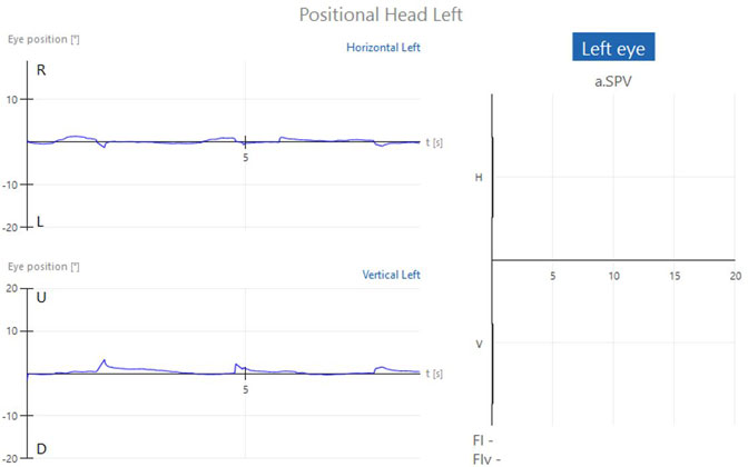 Graphs with eye position in degrees as a function of time in seconds. No horizontal or vertical nystagmus, visible by almost flat traces close to zero degrees. Another graph showing the average slow phase velocity also shows no horizontal or vertical nystagmus.