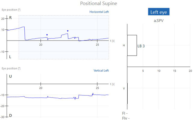 Graphs with eye position in degrees as a function of time in seconds. Two recorded beats of horizontal, left-beating nystagmus, yielding a left-beating nystagmus with an average slow phase velocity of 3. This is within the normal range of 0 to 6.